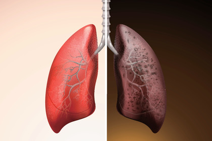 Ecco come diventano i polmoni di un fumatore