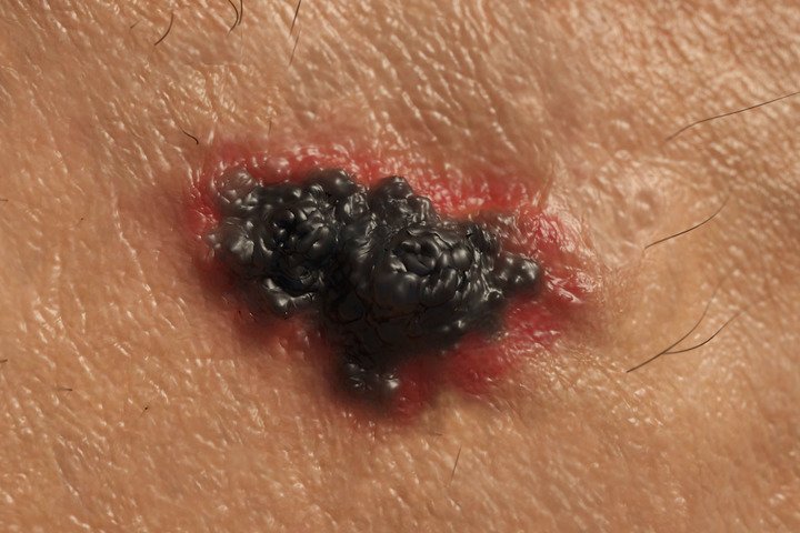 Come Viene Diagnosticato Il Melanoma Metastatico