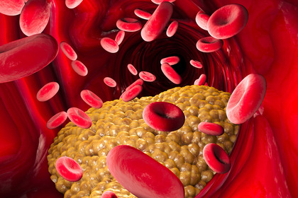 Colesterolo: ecco come interpretare correttamente i valori degli esami del sangue