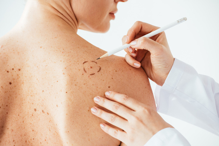 Il melanoma metastatico si può curare: 10 anni di successi