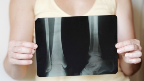 Nel mondo l’osteoporosi causa 25mila fratture al giorno
