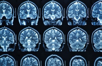 Cure più mirate per le metastasi cerebrali