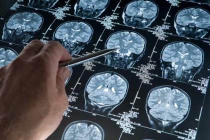 Morbo di Alzheimer: per anni abbiamo sbagliato strategia. Ora non più