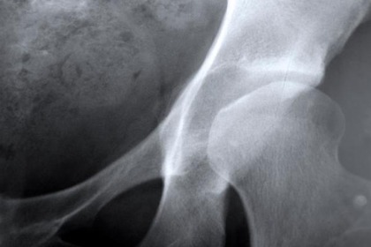 Fra 10 anni in Europa 34 milioni di donne con l'osteoporosi
